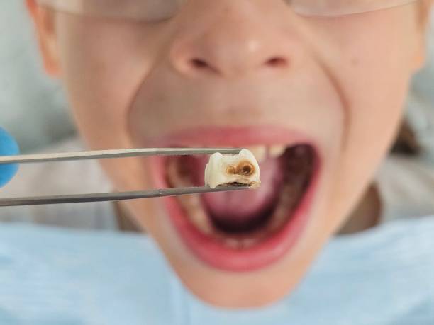 Best Emergency Wisdom Teeth Removal in Gleason, TN